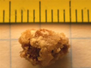 Kidney stone